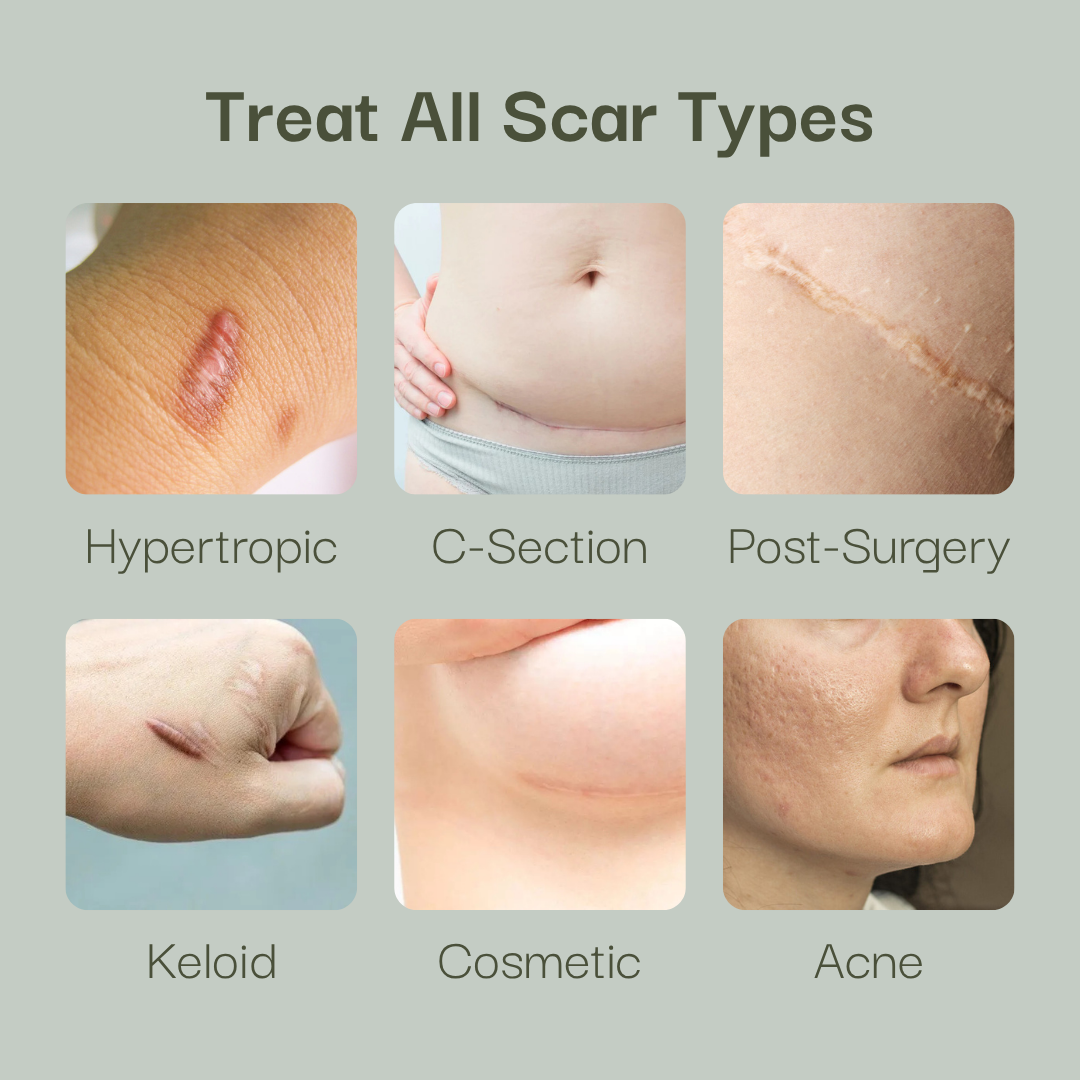 Helpful® Scar & Wrinkle Tape